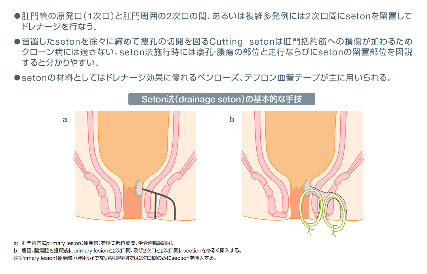 図．Seton法（drainage seton）