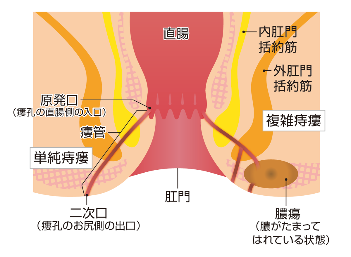 クローン病に伴う肛門周囲瘻孔について